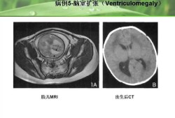 胎儿磁共振（新生儿照核磁共振是为什么）