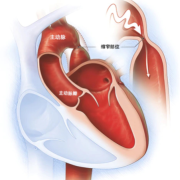 胎儿主动脉狭窄能要吗（什么是主动脉狭窄）