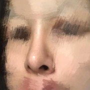 彭体隆鼻+耳软骨鼻尖一个月鼻头很硬正常么,孕期鼻子变硬怎么回事