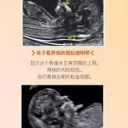 胎儿颈项透明层厚度正常值（胎儿颈项透明层厚度1.3是男孩女孩）