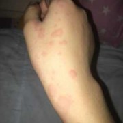 孕期寻麻疹（孕期寻麻疹怎么治疗）