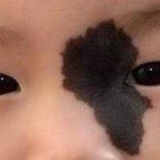 胎儿身上为啥有胎记（婴儿脸上有胎记是怎么回事）