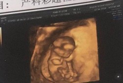 胎儿小三天（胎儿小三天正常吗）