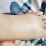 如何消除孕期水肿（怀孕为什么脚会肿，怀孕脚肿怎么办）