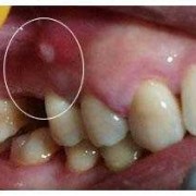 孕期根尖炎（孕期根尖炎疼怎么缓解）