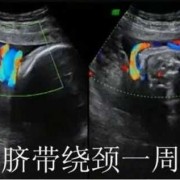 孕32周脐带绕颈一周怎么办？脐带绕颈，胎儿会窒息吗,胎儿脐带绕颈图片 彩超