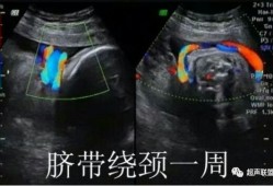 孕32周脐带绕颈一周怎么办？脐带绕颈，胎儿会窒息吗,胎儿脐带绕颈图片 彩超