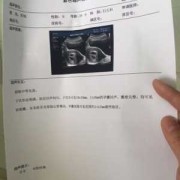胎儿左侧侧脑室（胎儿一侧侧脑室见宽约0,6cm液性暗区意味着什么）