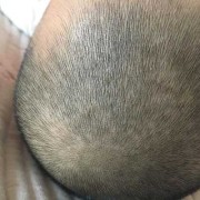 胎儿斑秃（斑秃会影响胎儿吗）