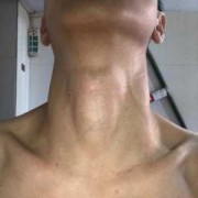 在喉结纹一条线叫什么,胎儿颈部见u型切迹是什么意思?