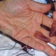 三十五周胎儿能存活吗（早产儿智力会有影响吗）