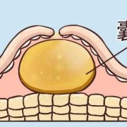 孕期有囊肿（囊肿怀孕25周要注意什么）