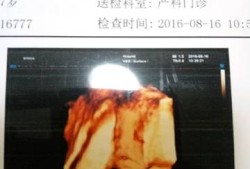 唐氏胎儿四维照片（唐筛没过做四维可以吗）