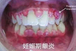 怀孕后，牙龈总是出血怎么办，并且出血还很多,怀孕期间牙龈老是出血怎么办