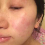孕期皮炎是怎么引起的（孕妇皮炎怎么引起的）