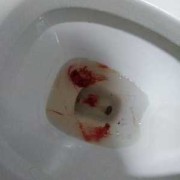 孕妇呕吐吐血怎么回事？原因是什么呢,孕期呕吐吐血怎么回事