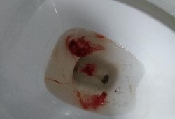 孕妇呕吐吐血怎么回事？原因是什么呢,孕期呕吐吐血怎么回事