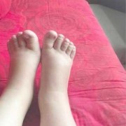 怀孕期间的孕妇，一般什么时候会开始水肿了,孕期什么时候水肿最严重