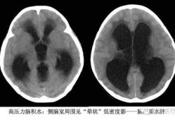 胎儿脑积水诊断标准（宝宝脑积水的初期表现是什么样的）