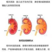胎儿右肾轻度积水（胎儿右肾轻度积水是什么意思）