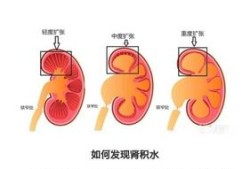胎儿右肾轻度积水（胎儿右肾轻度积水是什么意思）