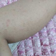 孕期腿上湿疹怎么办（腿上长满了湿疹，奇痒无比，怎么办啊）