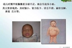 胎儿缺碘（胎儿缺碘）