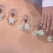 孕期能拔罐（孕期能拔罐）