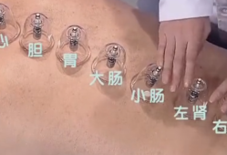 孕期能拔罐（孕期能拔罐）