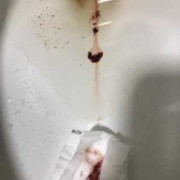 怀孕期间出血（怀孕期间出血是什么情况）