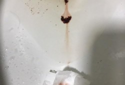 怀孕期间出血（怀孕期间出血是什么情况）
