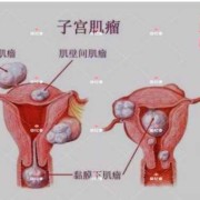 子宫肌瘤会影响胎儿发育吗（怀孕子宫肌瘤会影响胎儿发育吗）