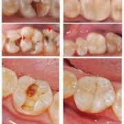 怀孕能补牙吗,怀孕补牙吗