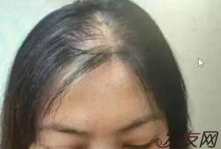 孕期头发变多,怀孕期间掉头发正常吗女性