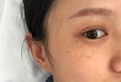 怀孕长斑怎么回事,怀孕期间长斑能恢复吗