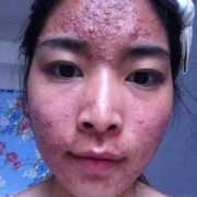 孕期痤疮怎么办（孕妇脸上长痘痘怎么调理？快四个月了，需要使用药物的吗）