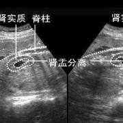 胎儿左肾盂分离是什么意思（b超胎儿左肾盂分离是什么意思）