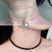 孕期颈纹（孕期颈纹很深产后会消失吗）
