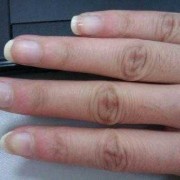 孕期身上有白点（指甲上有白斑是怎么回事）