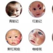 新生儿为什么有胎记,怎样预防胎儿长胎记的发生