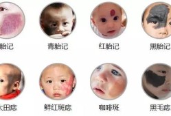 新生儿为什么有胎记,怎样预防胎儿长胎记的发生