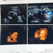 胎儿上唇连续是什么意思（胎儿上唇连续是什么意思）