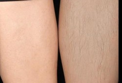 孕期体毛增多（孕期体毛增多变黑是男孩还是女孩）
