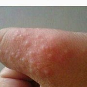 孕晚期脚上手上长了很多水泡如何处理,孕期手上起小水泡图片大全