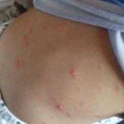 怀孕30几天长水痘有影响吗,孕期出水痘影响胎儿吗