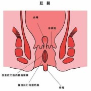 孕期痔疮肛裂（孕期痔疮肛裂）
