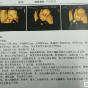 23周照四维，检查宝宝左侧脉络丛囊肿对宝宝有影响吗,双侧脉络丛囊肿胎儿能要吗