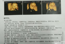 23周照四维，检查宝宝左侧脉络丛囊肿对宝宝有影响吗,双侧脉络丛囊肿胎儿能要吗