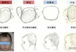 胎儿颅骨畸形（胎儿颅骨畸形的原因）