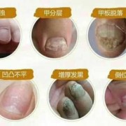 孕期灰指甲怎么办（孕妇有灰指甲怎么办?）